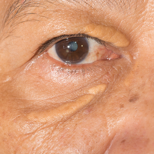 Υψηλή χοληστερίνη: Το σημάδι στα μάτια που δείχνει ανεβασμένη χοληστερόλη - Φωτογραφία 4