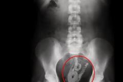 Ουπς κόλλησε-Τι ανακαλύπτουν οι γιατροί μέσα σε σώματα ασθενών