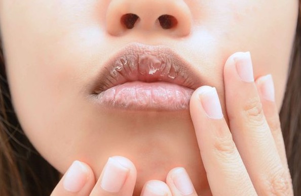 6 συνήθειες που ευθύνονται για τα σκασμένα χείλη σου - Φωτογραφία 1