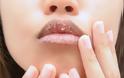6 συνήθειες που ευθύνονται για τα σκασμένα χείλη σου