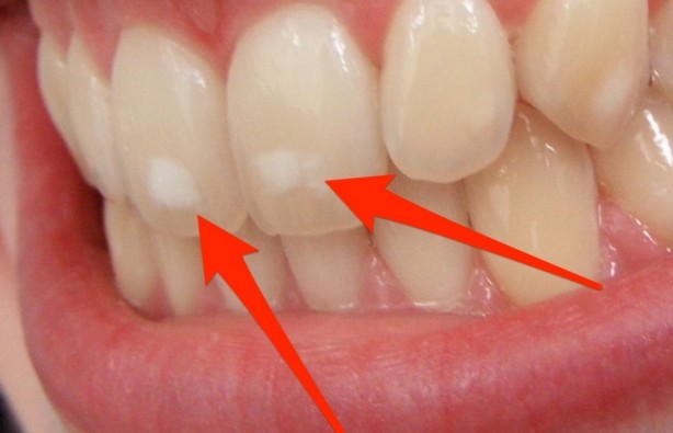 Πού οφείλονται αυτά τα λευκά σημάδια στα δόντια – Τι πρέπει να κάνετε... - Φωτογραφία 1