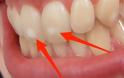 Πού οφείλονται αυτά τα λευκά σημάδια στα δόντια – Τι πρέπει να κάνετε...