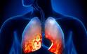 Προσοχή στον βήχα που γυρνάει σε πνευμονία - Ποια είναι τα ένοχα συμπτώματα