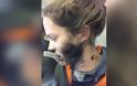 Τρομακτικτό ατύχημα: Εξερράγησαν τα ακουστικά στο πρόσωπό της εν μέσω πτήσ