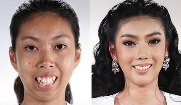 Ένα 19χρονο κορίτσι πριν και μετά τις πλαστικές επεμβάσεις - Φωτογραφία 1