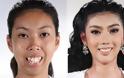 Ένα 19χρονο κορίτσι πριν και μετά τις πλαστικές επεμβάσεις