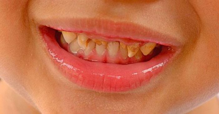 Ποια είναι η νούμερο 1 τροφή που χαλάει τα δόντια των παιδιών; - Φωτογραφία 1