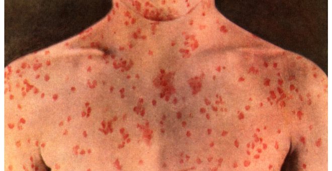 Προσοχή! Επιδημία ιλαράς στην Ευρώπη - Φωτογραφία 1