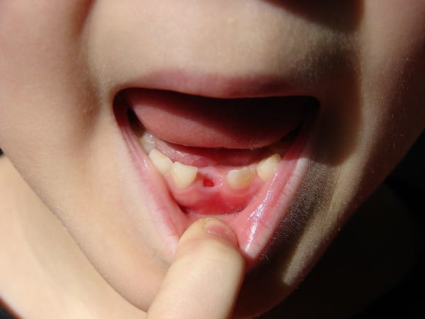Να γιατί πρέπει οι γονείς να κρατούν τα πρώτα δόντια των παιδιών τους - Φωτογραφία 1