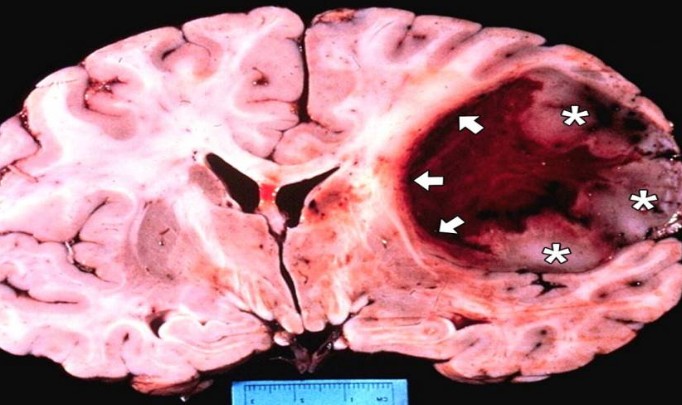 Βόμβα Ο καρκίνος ξεκινά από το μυαλό - Τα σημεία που «χτυπά» ανάλογα με τη διάθεση μας... (βίντεο) - Φωτογραφία 1