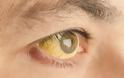 Κίτρινα μάτια: Τι σύμπτωμα είναι – Ποιοι πρέπει να προσέχουν
