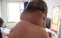 Ο αντρας με τον παραμορφωμένο λαιμό που σόκαρε τους γιατρούς παγκοσμίως: Δείτε πως το έπαθε και θα σας σηκωθεί η τρίχα [photos] - Φωτογραφία 4