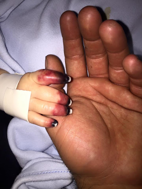 Όταν οι γιατροί εξέτασαν τα χέρια του μωρού, πανικοβλήθηκαν - Τότε, ανακοίνωσαν στους γονείς την ανατριχιαστική αλήθεια [photos] - Φωτογραφία 3