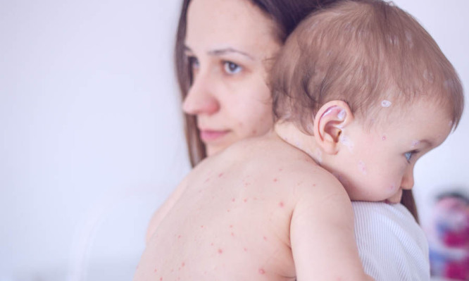 Επιδημία ιλαράς εξαιτίας του «εφιάλτη» των μη-εμβολιασμών – Προσοχή στα συμπτώματα - Φωτογραφία 1