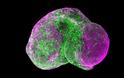Αυτισμός: Δημιούργησαν «μίνι-εγκεφάλους» σε εργαστήριο και «διόρθωσαν» τα προβληματικά κύτταρα