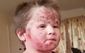 Σφίχτηε η καρδιά μας: 5χρονo παιδάκι έγδερνε το δέρμα του επειδή εθίστηκε στα στεροειδή της αλοιφής και δημιουργήθηκε τρομερό έκζεμα