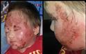 Σφίχτηε η καρδιά μας: 5χρονo παιδάκι έγδερνε το δέρμα του επειδή εθίστηκε στα στεροειδή της αλοιφής και δημιουργήθηκε τρομερό έκζεμα - Φωτογραφία 2