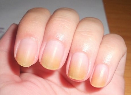 Νύχια που κιτρινίζουν: Αυτές είναι οι 4 βασικές αιτίες - Φωτογραφία 1