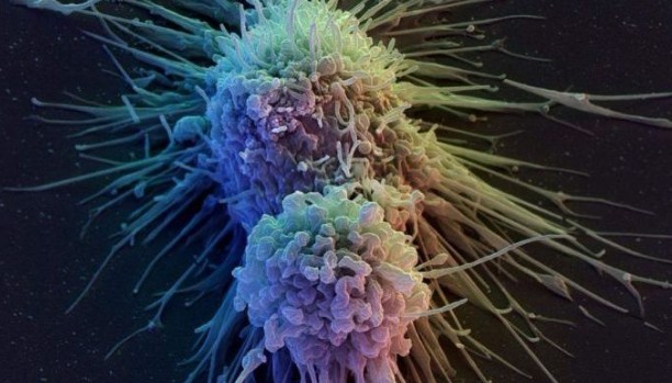 Τεστ αίματος ανιχνεύει τον καρκίνο ένα χρόνο πριν από τις ακτινογραφίες και τις τομογραφίες - Φωτογραφία 1