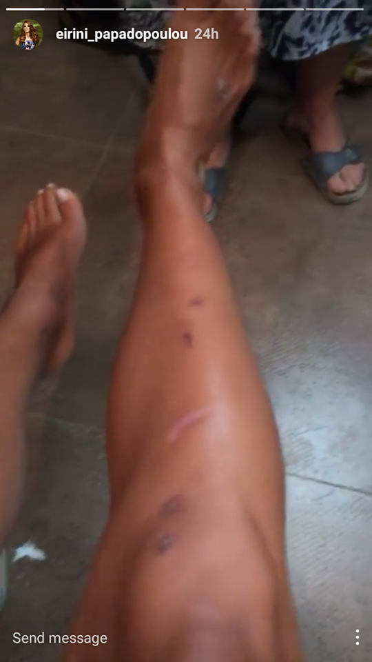 Ειρήνη Παπαδοπούλου: Σοκάρουν τα σημάδια στα πόδια της μετά το Survivor! (pics) - Φωτογραφία 3