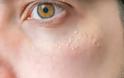 Υψηλή χοληστερίνη: Το σημάδι στα μάτια που δείχνει ανεβασμένη χοληστερόλη - Φωτογραφία 5