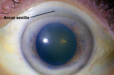Προσοχή - Υψηλή χοληστερίνη: Το σημάδι στα μάτια που δείχνει ανεβασμένη χοληστερόλη [pics] - Φωτογραφία 2