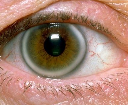 Προσοχή - Υψηλή χοληστερίνη: Το σημάδι στα μάτια που δείχνει ανεβασμένη χοληστερόλη [pics] - Φωτογραφία 3