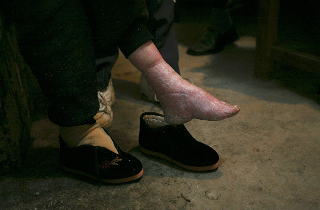 Τα πόδια του λωτού: Το απάνθρωπο κινέζικο έθιμο - Ο πραγματικός λόγος που οι Κινέζες έδεναν τα πόδια τους - Φωτογραφία 10