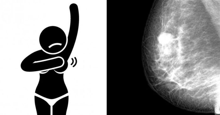 Aυτά είναι τα σιωπηλά συμπτώματα του καρκίνου στο στήθος που καμία γυναίκα δεν τα βλέπει.... - Φωτογραφία 1