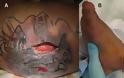 Συναγερμός: Νεκρός 31χρονος από σαρκοφάγο βακτήριο – Μολύνθηκε το φρέσκο τατουάζ του