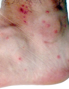 Σας τσίμπησαν κουνούπια, ακάρεα, σφήκες, κοριός; - Δείτε Πώς φαίνεται το κάθε τσίμπημα στο δέρμα για να ξέρετε τις σας τσίμπησε... [photos] - Φωτογραφία 10
