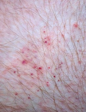 Σας τσίμπησαν κουνούπια, ακάρεα, σφήκες, κοριός; - Δείτε Πώς φαίνεται το κάθε τσίμπημα στο δέρμα για να ξέρετε τις σας τσίμπησε... [photos] - Φωτογραφία 3