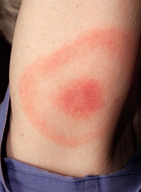 Σας τσίμπησαν κουνούπια, ακάρεα, σφήκες, κοριός; - Δείτε Πώς φαίνεται το κάθε τσίμπημα στο δέρμα για να ξέρετε τις σας τσίμπησε... [photos] - Φωτογραφία 5