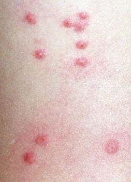 Σας τσίμπησαν κουνούπια, ακάρεα, σφήκες, κοριός; - Δείτε Πώς φαίνεται το κάθε τσίμπημα στο δέρμα για να ξέρετε τις σας τσίμπησε... [photos] - Φωτογραφία 6