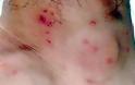 Σας τσίμπησαν κουνούπια, ακάρεα, σφήκες, κοριός; - Δείτε Πώς φαίνεται το κάθε τσίμπημα στο δέρμα για να ξέρετε τις σας τσίμπησε... [photos] - Φωτογραφία 10