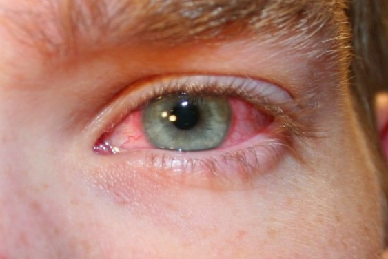 Επιπεφυκίτιδα: Αιτίες και συμπτώματα για ένα πολύ συχνό πρόβλημα στα μάτια - Φωτογραφία 1