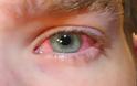 Επιπεφυκίτιδα: Αιτίες και συμπτώματα για ένα πολύ συχνό πρόβλημα στα μάτια