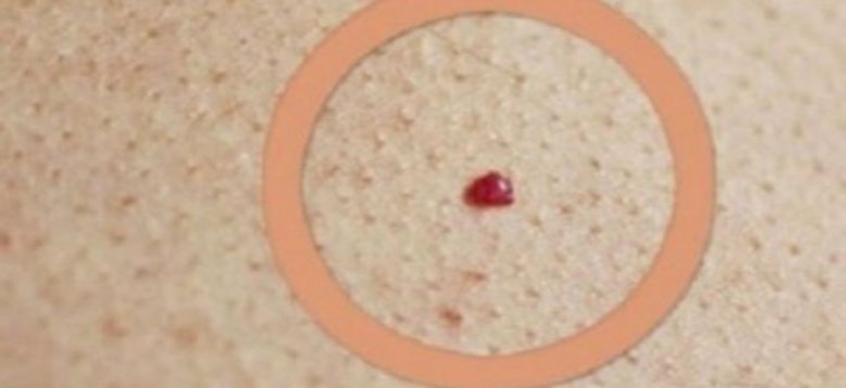 Προσοχή! Αν δείτε αυτό το κόκκινο σημάδι πάνω σας που μοιάζει με ελιά, τρέξτε αμέσως στον γιατρό - Φωτογραφία 1