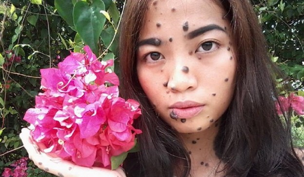 Η 20χρονη με τις ελιές στο πρόσωπο και στο σώμα που θέλει να γίνει Μις Υφήλιος - Φωτογραφία 1