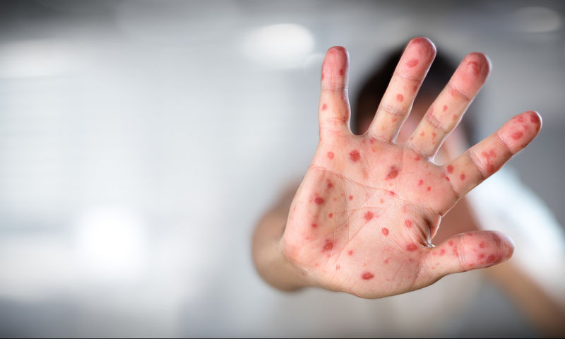ΠΟΥ: «Απαράδεκτη τραγωδία» οι 35 θάνατοι από ιλαρά στην Ευρώπη - Φωτογραφία 1