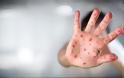 ΠΟΥ: «Απαράδεκτη τραγωδία» οι 35 θάνατοι από ιλαρά στην Ευρώπη