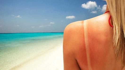 Δέρμα: «Λίγο βούτυρο για το έγκαυμα» και άλλοι μύθοι για το καλοκαίρι - Φωτογραφία 1