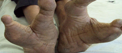 Φυλή Vadoma: Οι άνθρωποι με τα πόδια που θυμίζουν στρουθοκάμηλο (φωτό, βίντεο) - Φωτογραφία 1