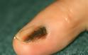 Μελάνωμα στο νύχι, στις άκρες των δακτύλων. Σκούρες γραμμές στα νύχια μπορεί να οφείλονται σε αιμάτωμα ή καρκίνο;
