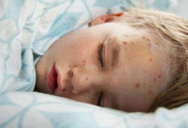 Κρούσματα ιλαράς σε Χανιά και Ηράκλειο - Οδηγίες για σωστό εμβολιασμό - Φωτογραφία 1