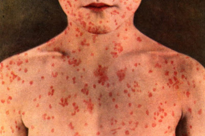 Τι είναι η ιλαρά; Ποια τα συμπτώματα, ποιοι θεωρούνται ασφαλείς και ποιοι πρέπει να εμβολιαστούν; - Φωτογραφία 1