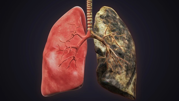 Τι κάνει το τσιγάρο στους πνεύμονες: Το βίντεο που σόκαρε τους καπνιστές παγκοσμίως - Φωτογραφία 3