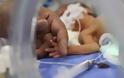 Ένα λιλιπούτειο θαύμα! Το συγκλονιστικό βίντεο ενός μωρού που γεννήθηκε μόλις 500 γραμμάρια... [video]