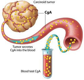 Xρωμογρανίνη, ειδική εξέταση για καρκίνους του ενδοκρινικού και νευρικού συστήματος, του προστάτη και του πνεύμονος - Φωτογραφία 1