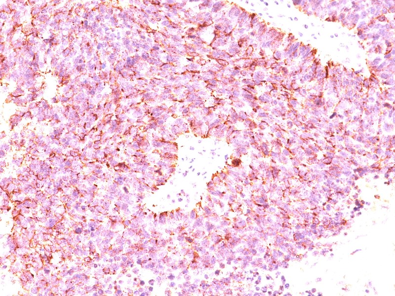 Xρωμογρανίνη, ειδική εξέταση για καρκίνους του ενδοκρινικού και νευρικού συστήματος, του προστάτη και του πνεύμονος - Φωτογραφία 3
